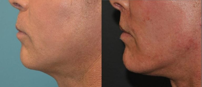 56-year old-Male-square-chin-implant-3-years-after-surgery-side-view