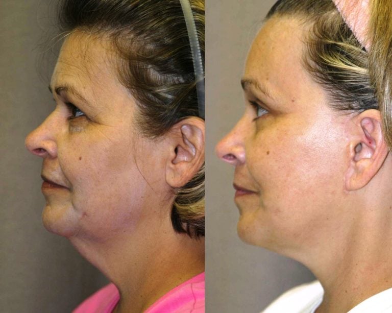 57 year-old, 9 month follow-up after facelift, lower external blepharoplasty with lateral canthoplasty, endoscopic browlift with endotine fixation,side view