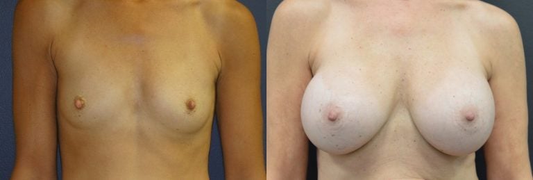57-year-old 16 years after breast augmentation, smooth round high profile saline 350cc, front