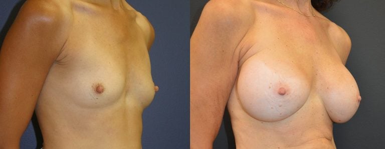 57-year-old 16 years after breast augmentation, smooth round high profile saline 350cc, oblique