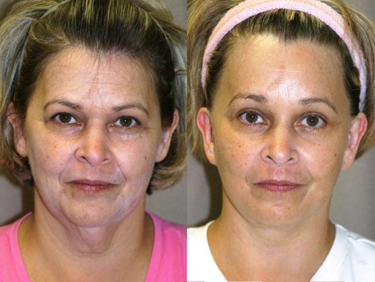 57-year-old-9-month-follow-up-after-facelift-lower-external-blepharoplasty-with-lateral-canthoplasty-endoscopic-browlift-with-endotine-fixation