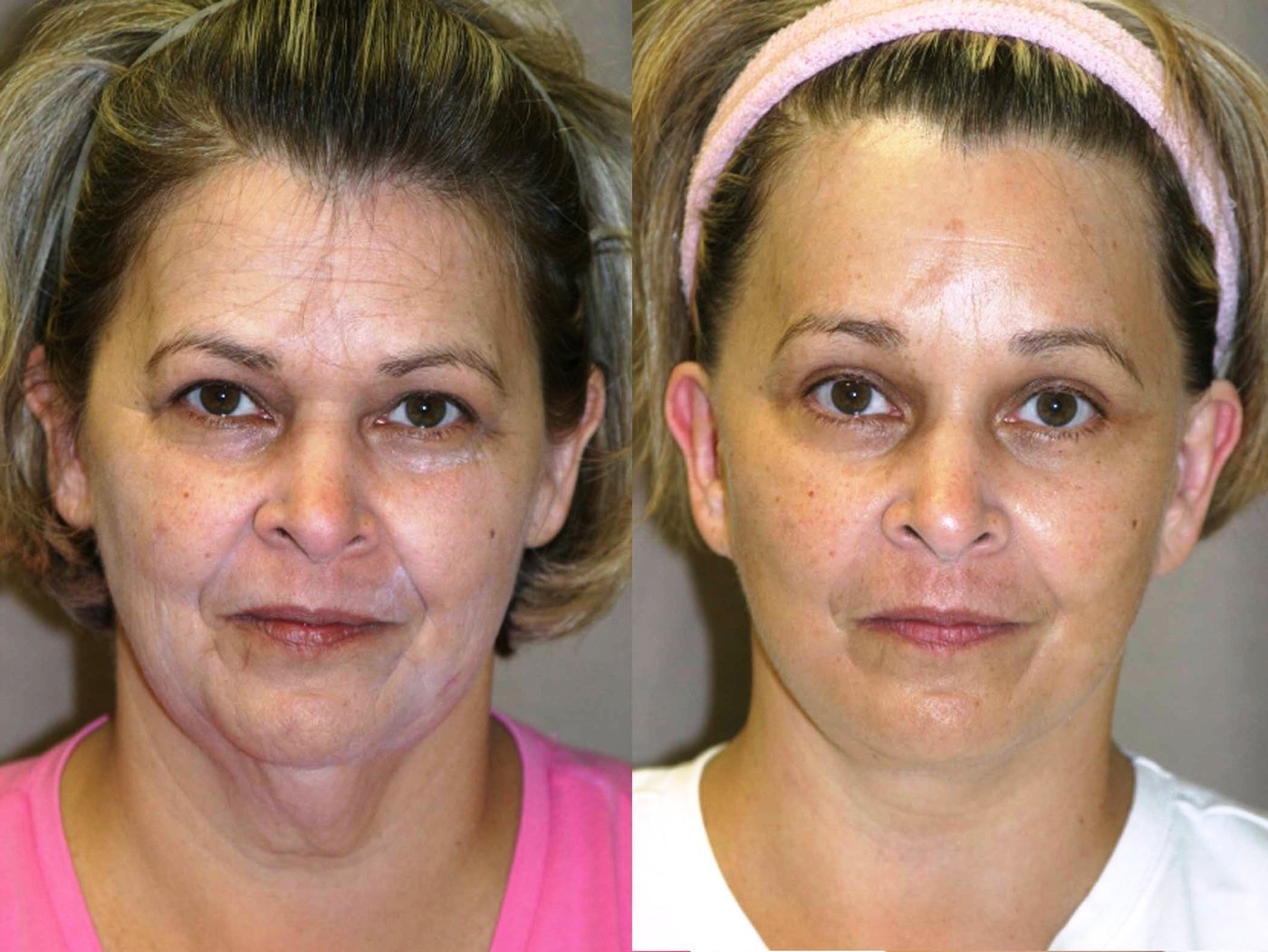 57 year old, Facelift, Lower Blepharoplasty (eyelids), Endoscopic Browlift