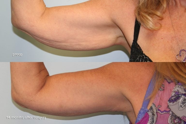 57-year-old-brachioplasty-14-months-right-front-scaled