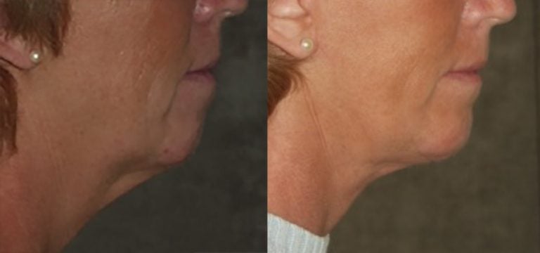 57 year old edit facelift chin augmentation 4 months after surgery copy