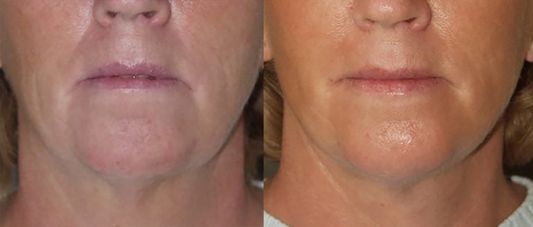 57-year-old-edit-front-facelift-chin-augmentation-4-months-after-surgery