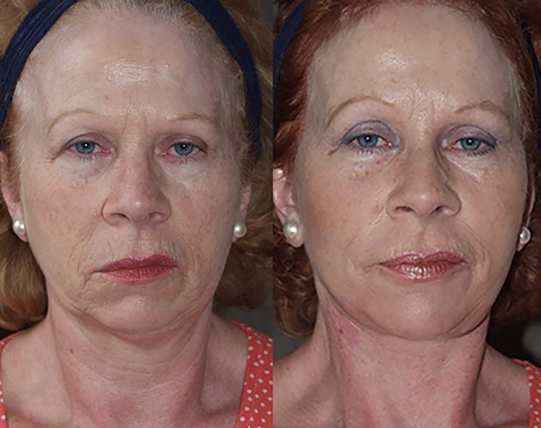57-year-old-facelift-browlift-upper-lower-eyelids-chin-implant-6-months-front
