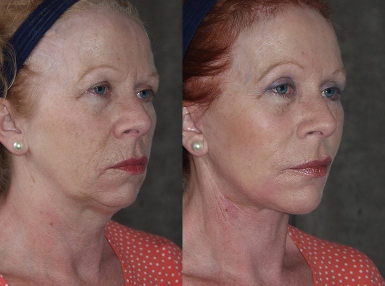 57-year-old-facelift-browlift-upper-lower-eyelids-chin-implant-6-months-oblique