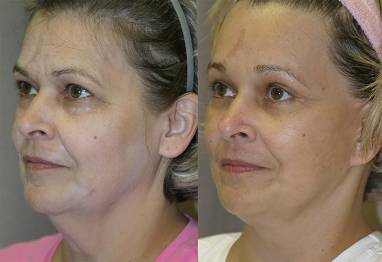 57-year-old-facelift-submental-platysmaplasty-endobrow-upper-lower-eyelids-oblique