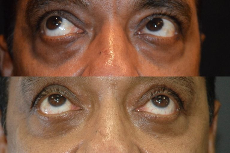 57-year-old lower eyelid transconjunctival bleph w. fat transposition, 2 years after surgery upward gaze