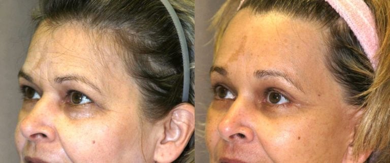 57 year-old, one year after brow lift, oblique view