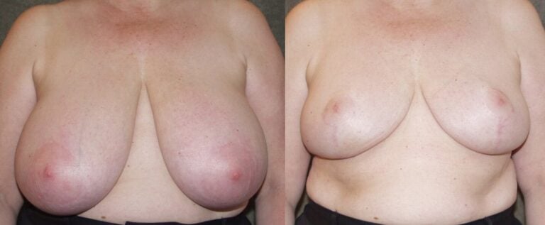 58-year-old-breast-reduction-inferior-pedicle-10-months-front