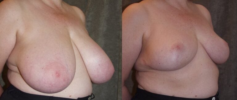 58-year-old-breast-reduction-inferior-pedicle-10-months-right-oblique