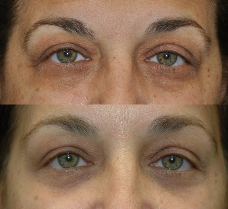 The forward gaze of a 58-year-old patient six weeks after her procedure. She’s had an endoscopic browlift, lower eyelid transconjunctival blepharoplasty with fat transposition, and Kirwan skin brightening cream. 