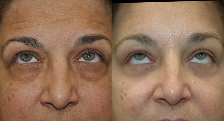 58 year old endoscopic browlift lower eyelid transconctival bleph. w. fat tranposition KIRWAN Skin Brightening Cream 6 weeks upward gaze