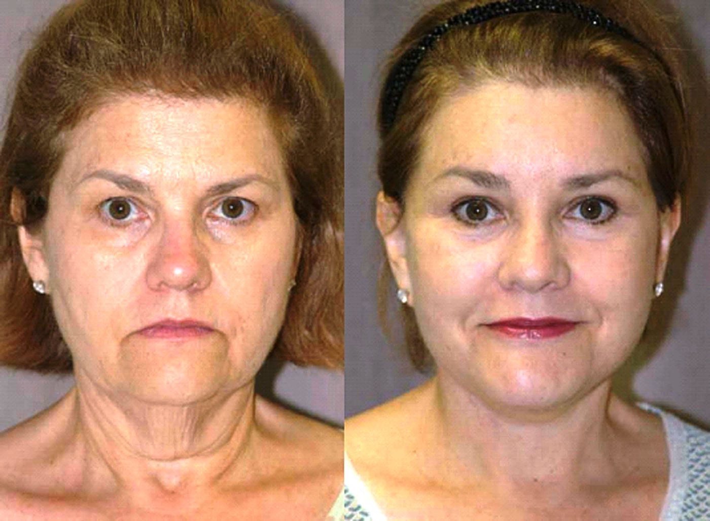 58-year-old-face-lift-brow-lift-eyelids-and-chin-augmentation-6-month-follow-up