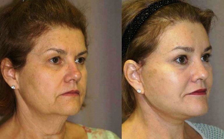 58-year-old-face-lift-brow-lift-eyelids-and-chin-augmentation-oblique-view-6-month-follow-up