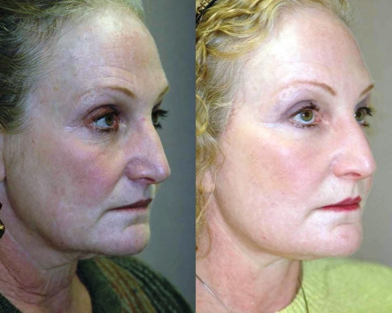 59-year-old-1500-face-lift-with-submental-plication-of-platysma-muscles-laser-lower-eyelids-and-lateral-canthoplasty-oblique-view