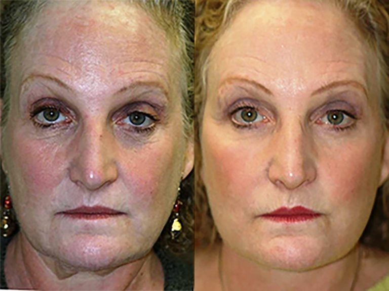 59-year-old-1500-pixels-face-lift-with-submental-plication-of-platysma-muscles-laser-lower-eyelids-and-lateral-canthoplasty-front