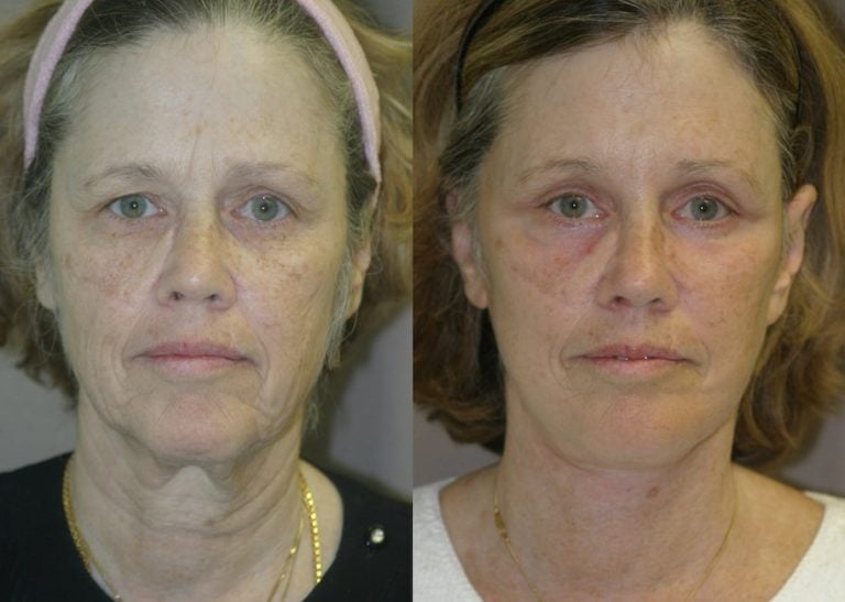 59-year-old, facelift, submental platysmaplasty, endobrow, upper _ lower eyelids, chin augmentation, 5 months after surgery front view