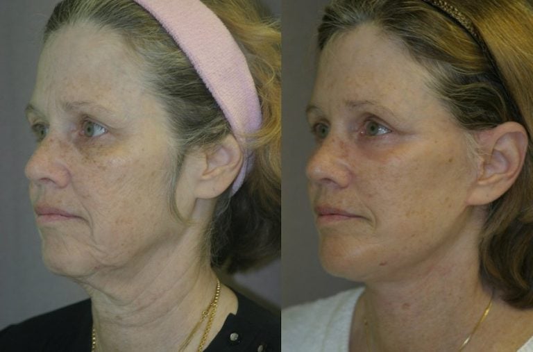 59-year-old, facelift, submental platysmaplasty, endobrow, upper _ lower eyelids, chin augmentation 5 months after surgery, left oblique view