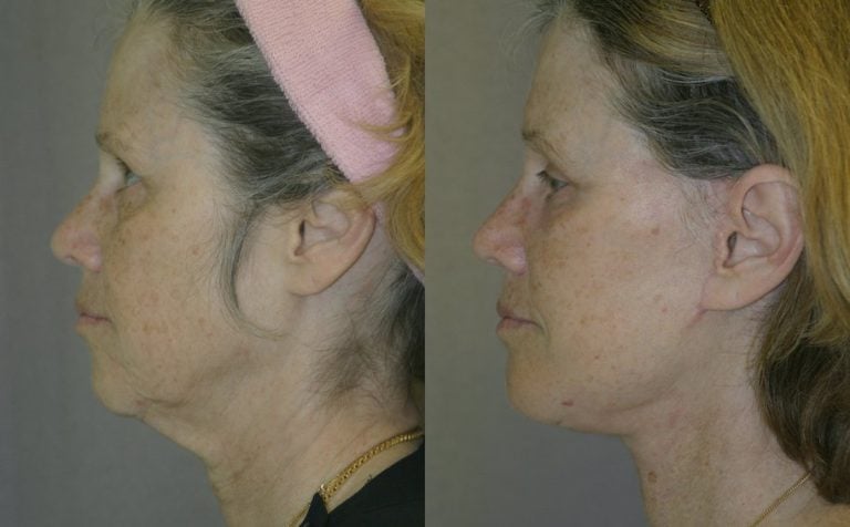 59-year-old-5-months-after-facelift-submental-platysmaplasty-endobrow-upper-lower-eyelids-chin-augmentation-left-side-view