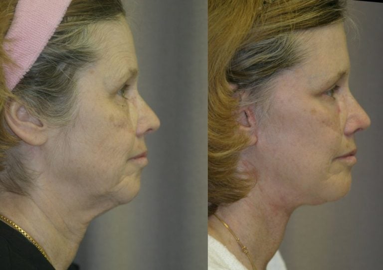 59-year-old, 5 months after facelift, submental platysmaplasty, endobrow, upper _ lower eyelids, chin augmentation, right side view