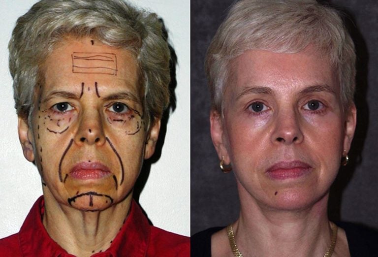 56-year-old, facelift, submental platysmaplasty, endobrow, upper lower eyelids, chin augmentation, 2 years after surgery, front view