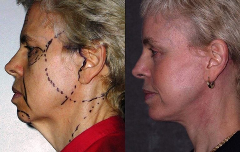 56-year-old, facelift, submental platysmaplasty, endobrow, upper lower eyelids, chin augmentation, 2 years after surgery, side view