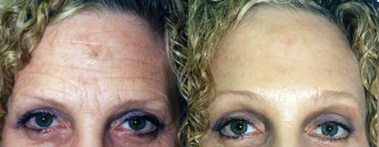 59 year-old face-lift browlift, laser lower eyelids and lateral canthoplasty
