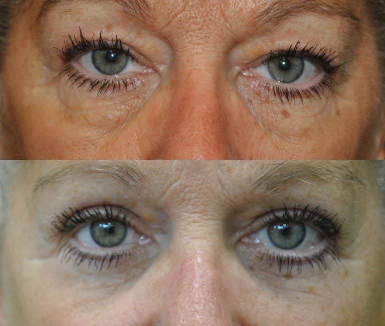 This 59-year-old patient is seen before and five months after her upper and lower blepharoplasty. Her forward gaze shows the external lower view with the transposition of lower fat pads. 