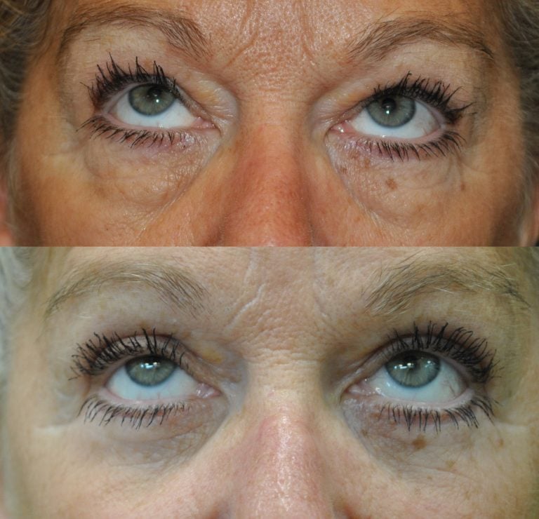 The same patient is seen with an upward gaze.