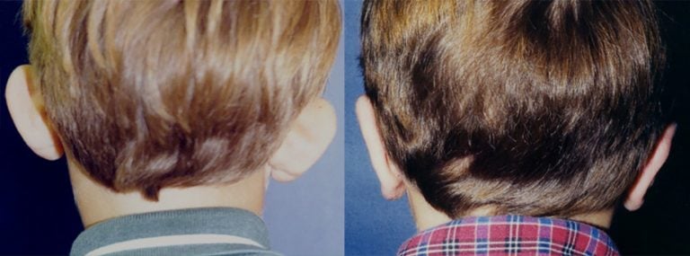 6-year-old-male-bilateral-otoplasty-back