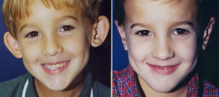 6-year-old-male-bilateral-otoplasty-front