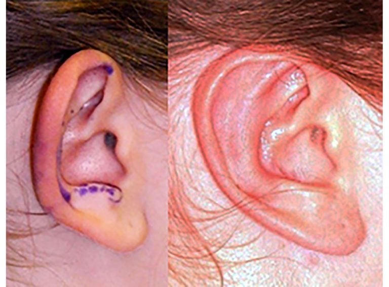 13-year-old female bilateral otoplasty, right ear, side