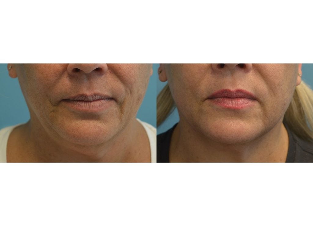 Morpheus8, Facetite Peri-Oral & neck front