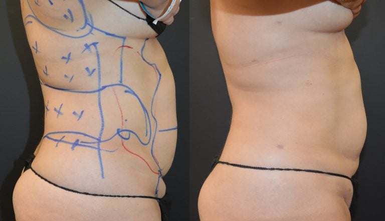 60-year-old-5-months-after-liposuction-of-flanks-iliac-crests-and-abdomen