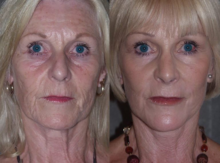 60-year-old-facelift-upper-lower-eyelids-chin-implant-rhinoplasty-peel-lower-eyelids-perioral-4-months