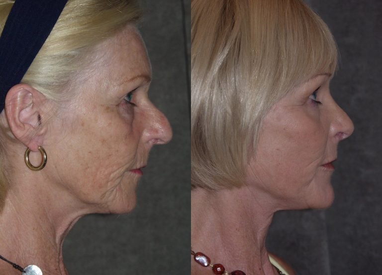 60-year-old-facelift-upper-lower-eyelids-chin-implant-rhinoplasty-peel-lower-eyelids-perioral-4-months-side