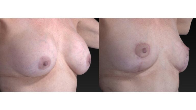 61-year-old 12 years after breast augmentation (right oblique) three months after removal of implants, breast auto-augmentation™ & fat injection