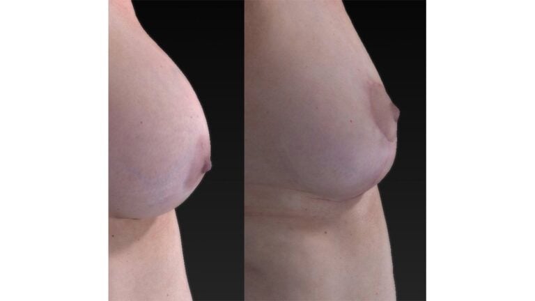 61-year-old 12 years after breast augmentation (right) three months after removal of implants, breast auto-augmentation™ & fat injection w. liposuction abdomen and hips (left) right side