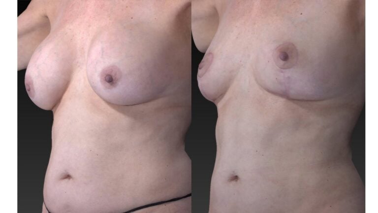 61-year-old 12 years after breast augmentation (right oblique) three months after removal of implants, breast auto-augmentation™ & fat injection w. liposuction abdomen and hips (left) left oblique