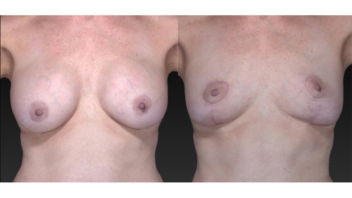61 year old 12 years after breast augmentation three months after removal of implants, breast auto augmentation™ & fat injection, front