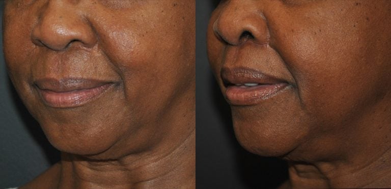 61 year-old patient, lip lift re-do - 2