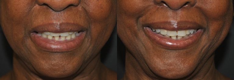 61 year-old patient, lip lift re-do - 1