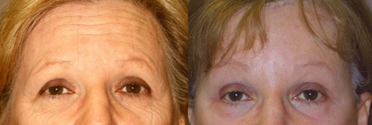 62-year-old facelift, browlift, hairline approach, upper & lower eyelids, chin implant, rhinoplasty subtle without fracture nasal domes, peel lower eyelids & perioral, 4 months