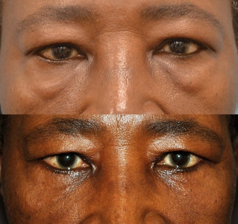 The forward gaze of a 62-year-old patient six months after his lower external blepharoplasty