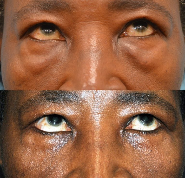 The upward gaze of the same patient