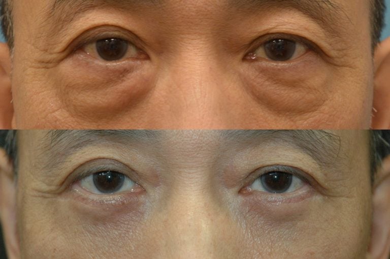62-year-old-lower-eyelid-transconjunctival-bleph-w.-fat-transposition-four-months-after-surgery-forward-gaze