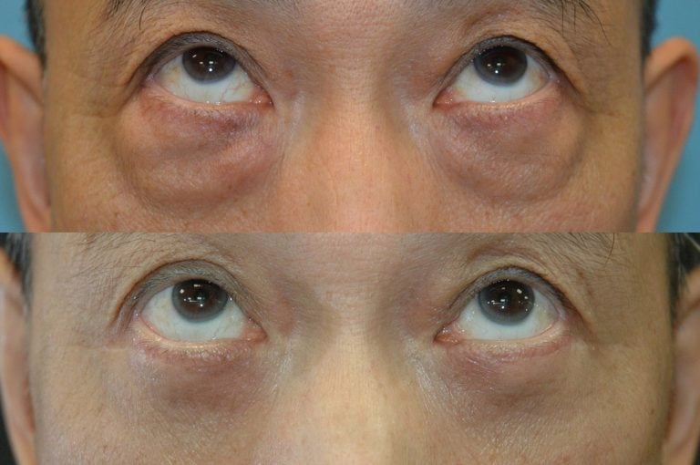 62-year-old-lower-eyelid-transconjunctival-bleph-w.-fat-transposition-.-four-months-after-surgery-upward-gaze