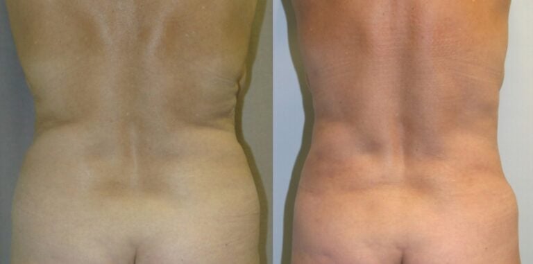 62-year-old-tummy-tuck-one-year-liposuction-back